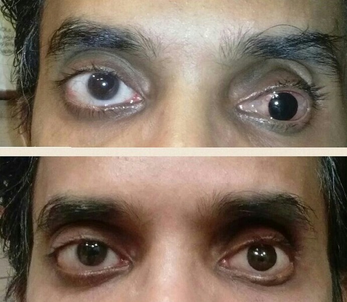 Artificial eye in mumbai
